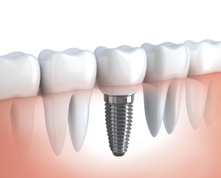 Implantologia Studio dentistico D'Amato Luigi Ariano Irpino Avellino