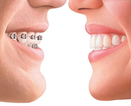 Ortodonzia apparecchio denti fisso mobile trasparente Ariano Irpino Avellino D'Amato