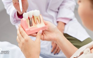 Implantologia-Dentale-ad-Ariano-Irpino-in-provincia-di-Avellino